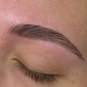 Browlift